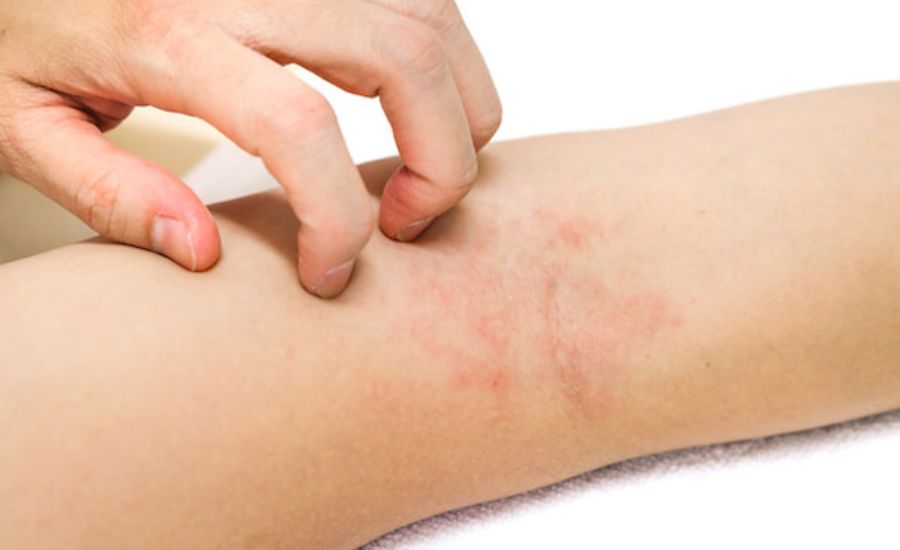 Eczedone: Natural Relief for Eczema-Prone Skin 2 What Makes Eczedone Different from Other Eczema Treatments