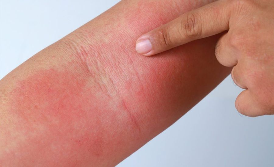 Eczedone: Natural Relief for Eczema-Prone Skin 3 Who Should Consider Eczedone, and How to Use It Effectively